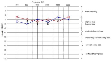 How to Read An Audiogram (Hearing Test) .